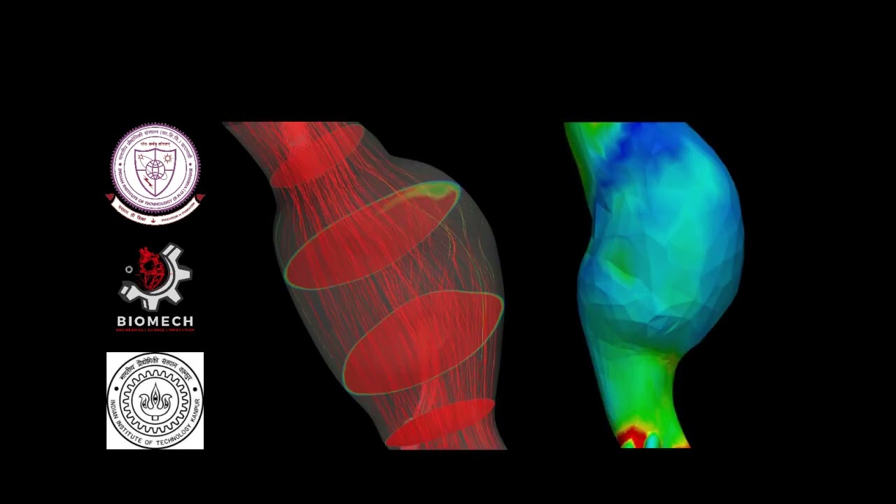 Individuare, prevedere e prevenire le rotture dell’aorta