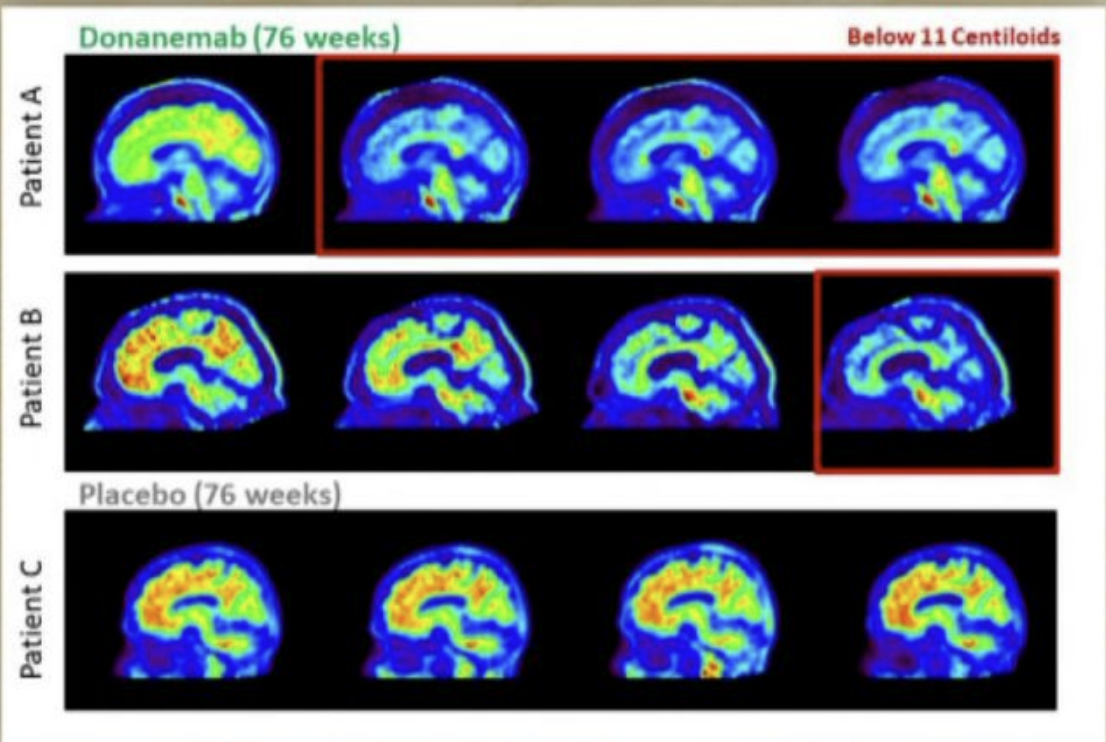 Un farmaco sperimentali contro l’Alzheimer ha dato risultati incoraggianti