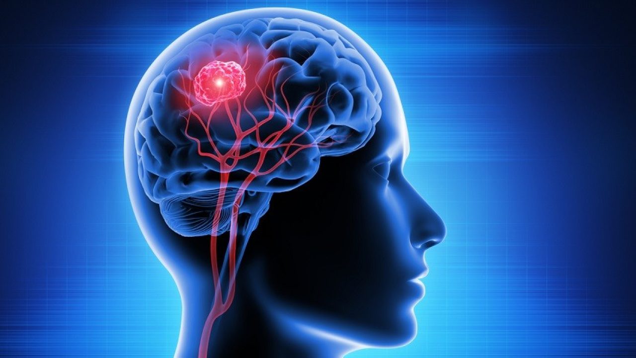 La rivoluzione contro i tumori cerebrali: la nuova molecola fa autodistruggere il glioblastoma, senza effetti collaterali