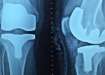 Infezioni periprotesiche: i fattori di rischio dopo un intervento di artroplastica del ginocchio