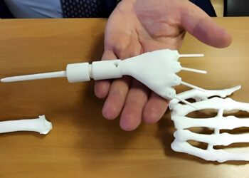 Protesi stampata in 3D: primo intervento al mondo salva la mano destra