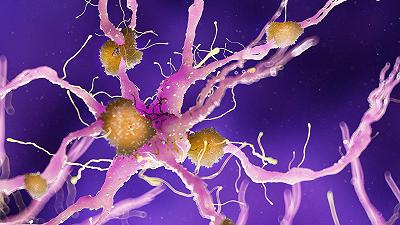 Alzheimer: nuova speranza grazie all’anticorpo monoclonale donanemab