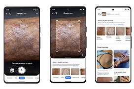 Google Lens fa il dermatologo: ora riconosce le condizioni della pelle, delle unghie e dei capelli