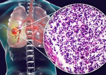 Tumore polmonare a piccole cellule: terapia innovativa per gli over 65