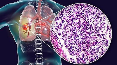 Tumore polmonare a piccole cellule: terapia innovativa per gli over 65