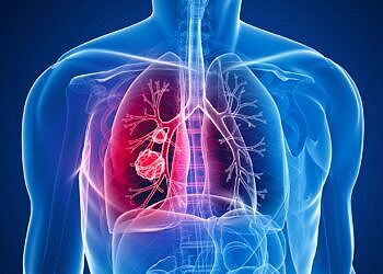 Tumore del polmone: buoni risultati con lo screening del progetto Risp