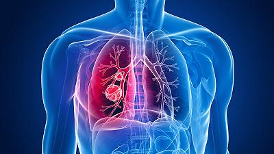 Tumore del polmone: buoni risultati con lo screening del progetto Risp