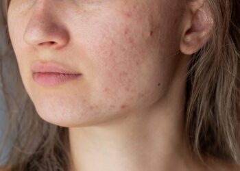 Acne e dermatite atopica: uno studio rivela incidenza e gestione