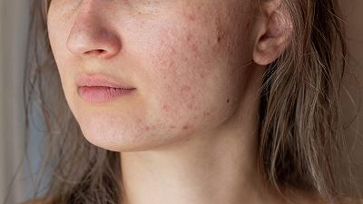 Acne e dermatite atopica: uno studio rivela incidenza e gestione
