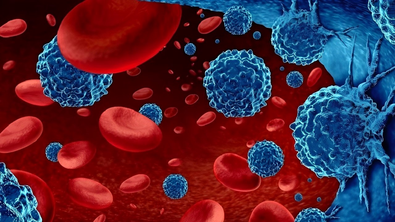 Mieloma multiplo: nuovo documento per migliorare l’assistenza ai pazienti