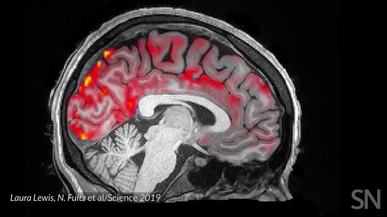 Il diabete è collegato a cambiamenti funzionali e strutturali del cervello: la nuova scoperta