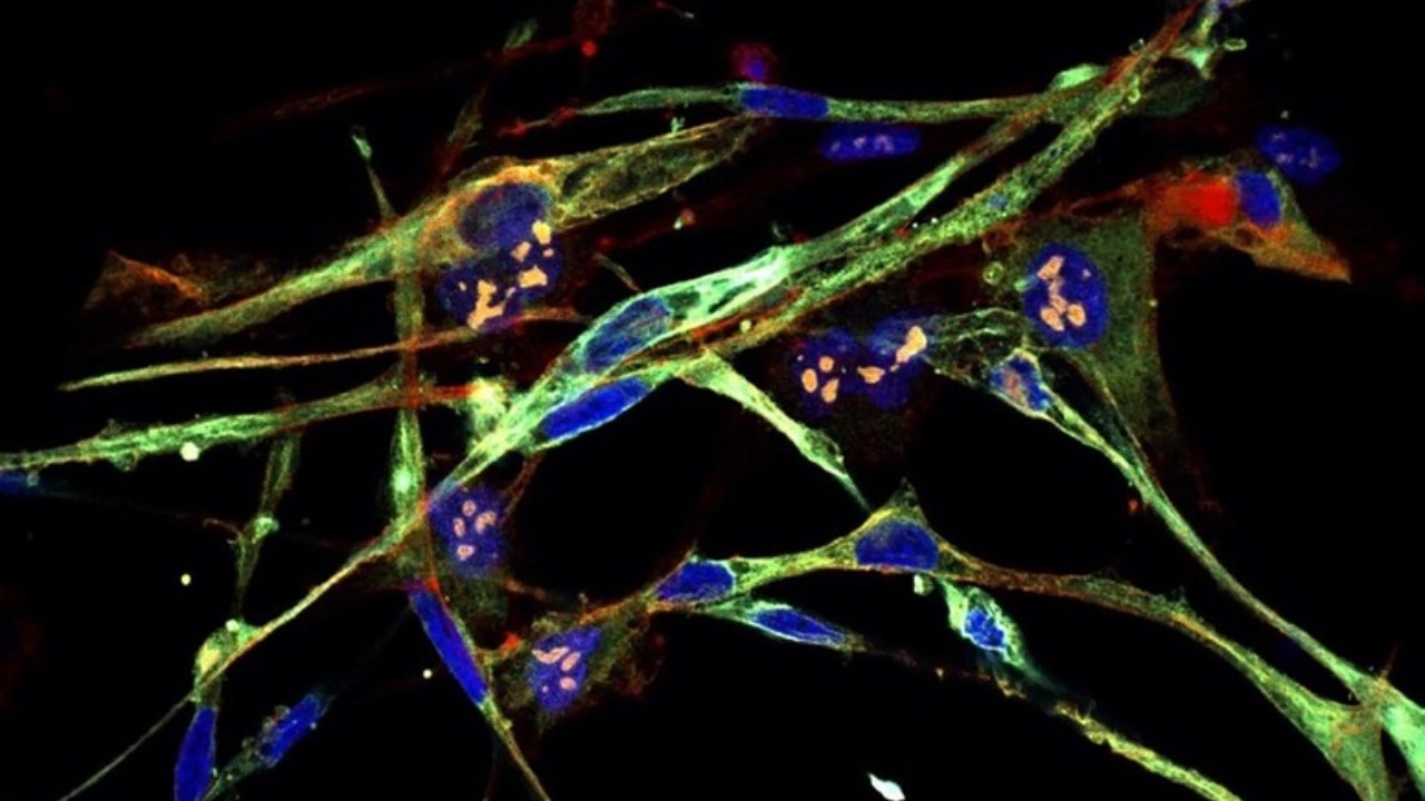 Gene silenziato trasforma le cellule tumorali in cellule sane: scoperta rivoluzionaria