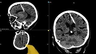 Vivere con un ago nel cervello per 80 anni: l’incredibile storia di una donna russa