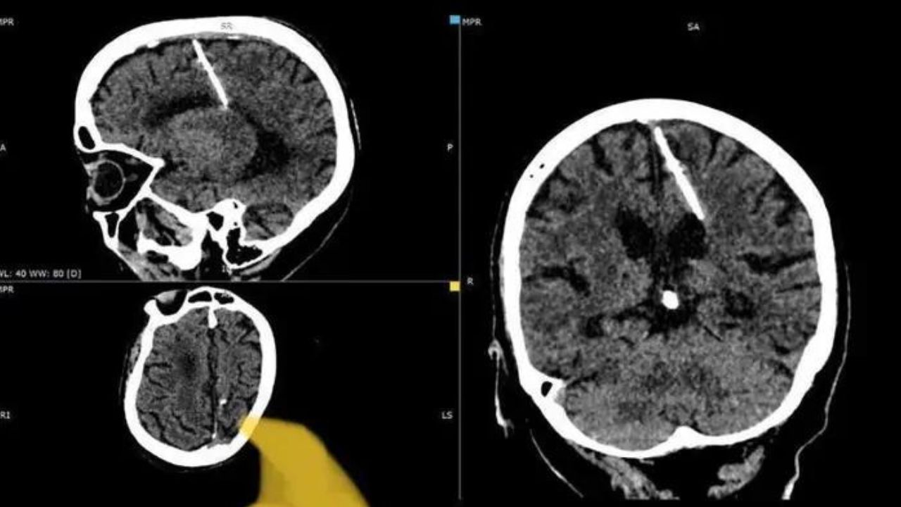 Vivere con un ago nel cervello per 80 anni: l’incredibile storia di una donna russa