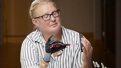 Mano bionica: impianto connesso a muscoli e nervi per una donna svedese
