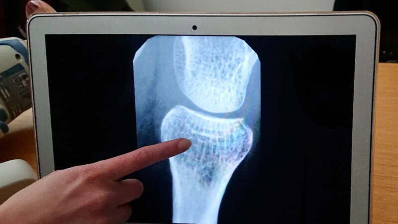 Osteoporosi: inaugurato il primo “Bone Center” in Italia