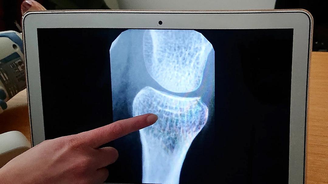 Osteoporosi: inaugurato il primo “Bone Center” in Italia