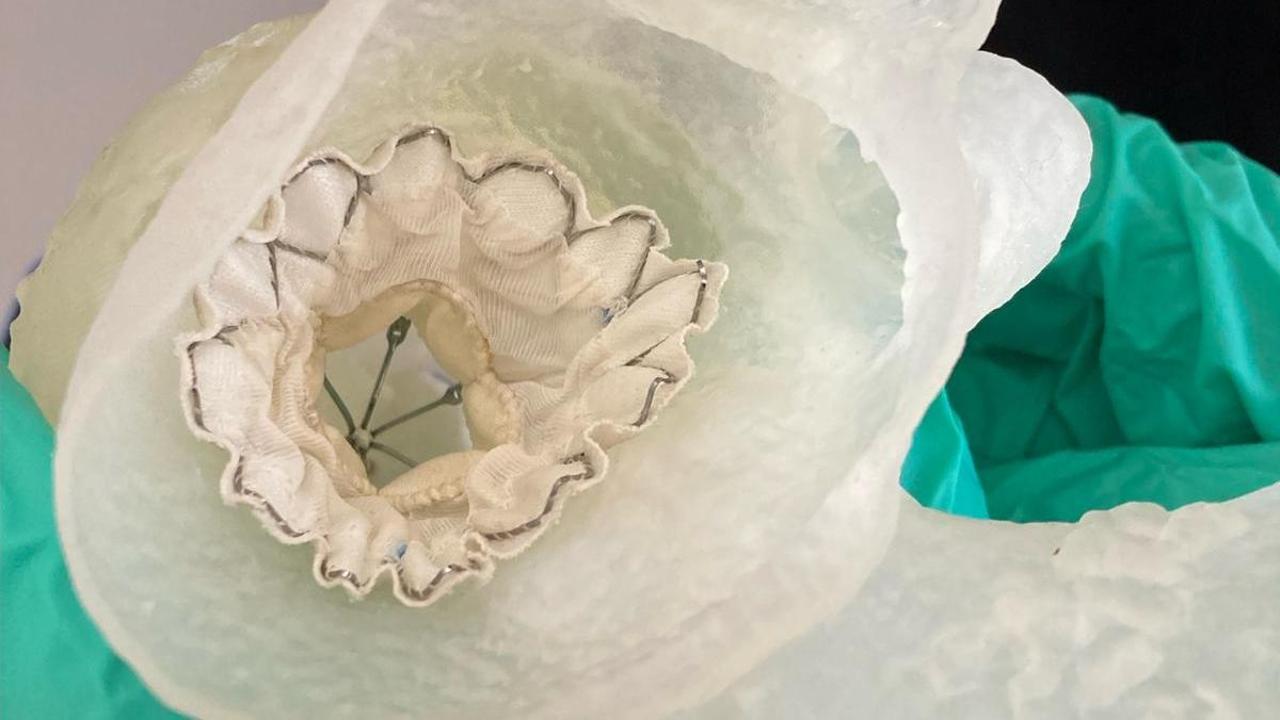 Protesi a cuore battente in 3D: chirurghi e ingegneri collaborano in un intervento avanzato