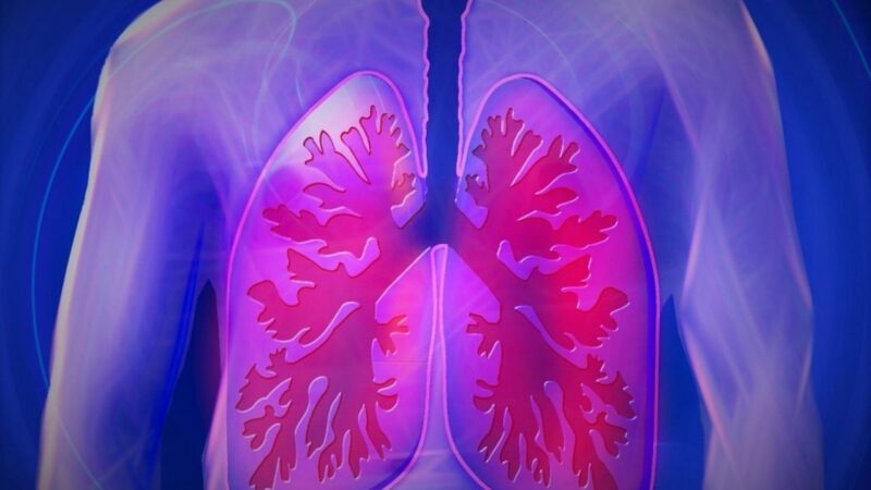 Tumore al polmone: riduzione del rischio di morte del 28% con immunoterapia