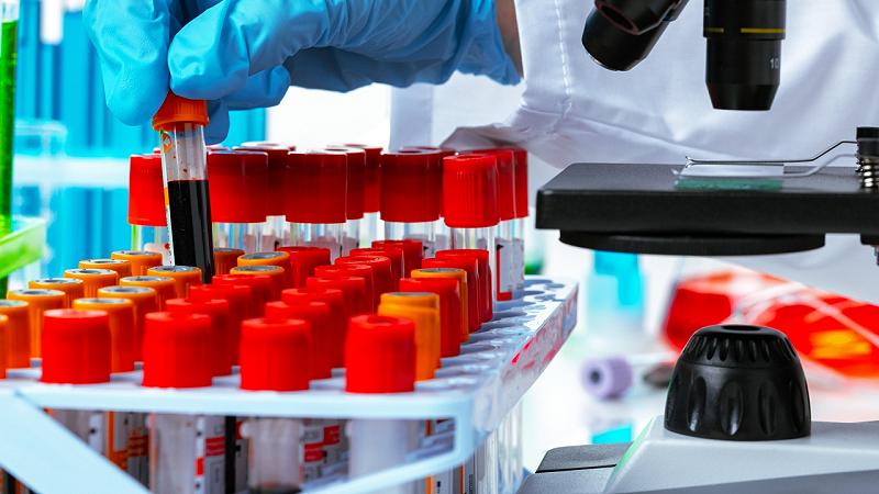 esame del sangue basato su IA individua i primi segnali del cancro al seno