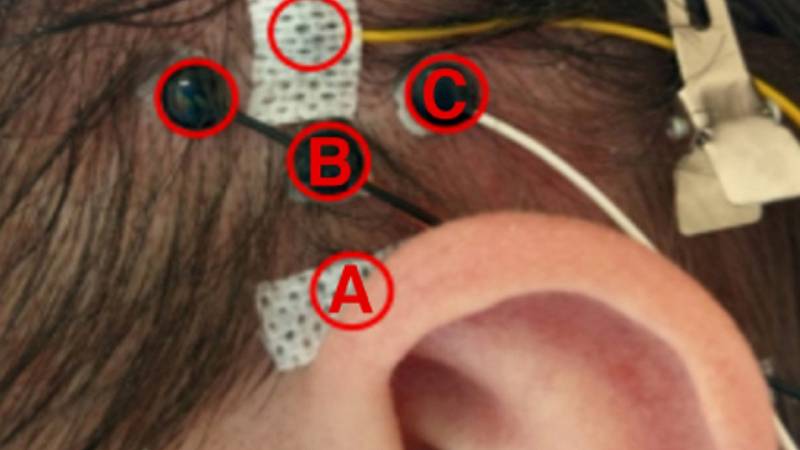 cinque elettrodi EMG sono stati posizionati sulle teste dei volontari per registrare i segnali