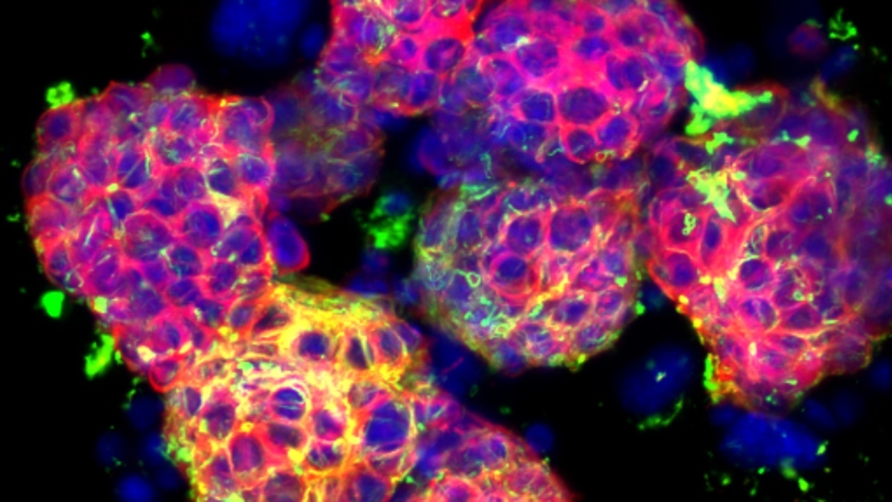 Ricerca sul neuroblastoma: nuove speranze per i pazienti ad alto rischio