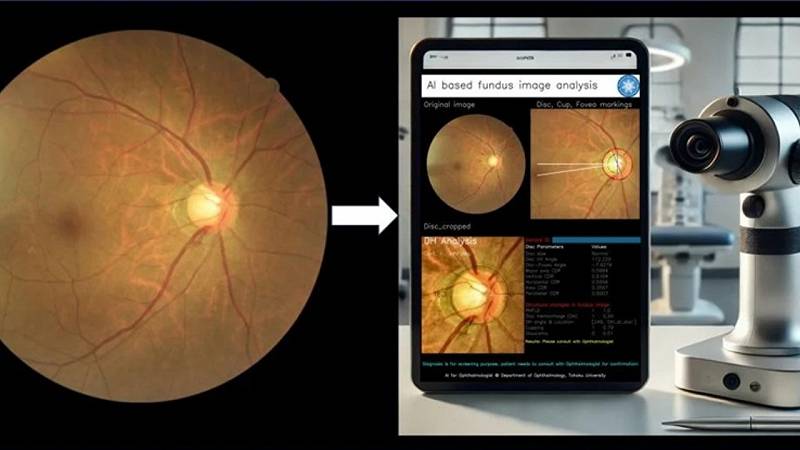 screening del glaucoma