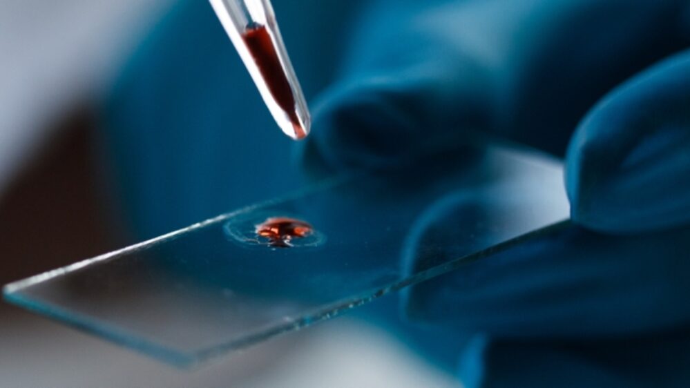 prelievo di sangue per la malattia di Alzheimer