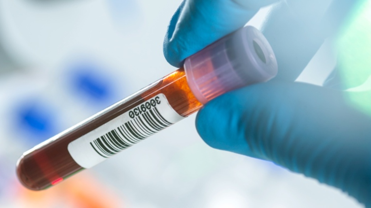 La FDA approva un esame del sangue che potrebbe anticipare l’Alzheimer