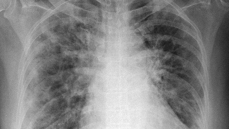 radiografie del torace