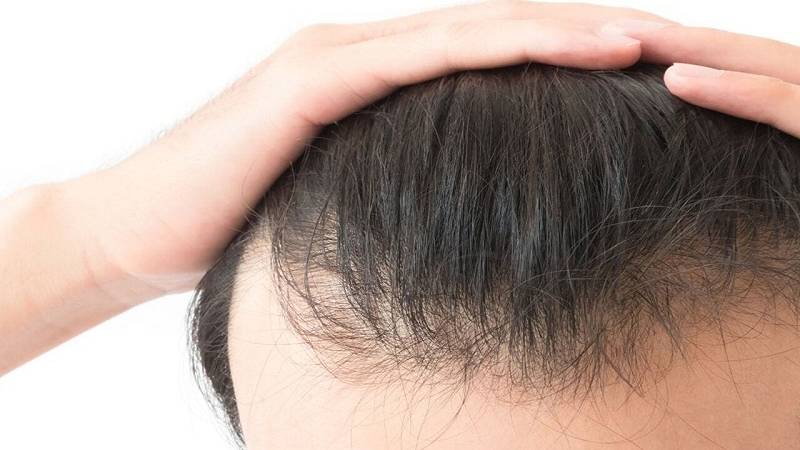 bevande zuccherate e perdita dei capelli