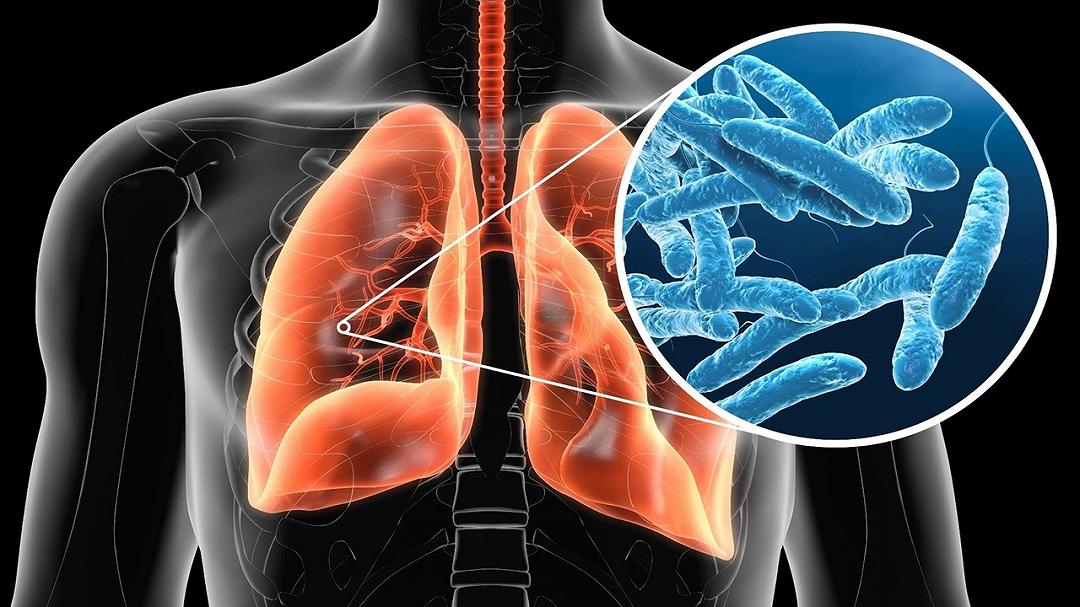 La malattia del legionario lascia strascichi? Un nuovo studio sta indagando