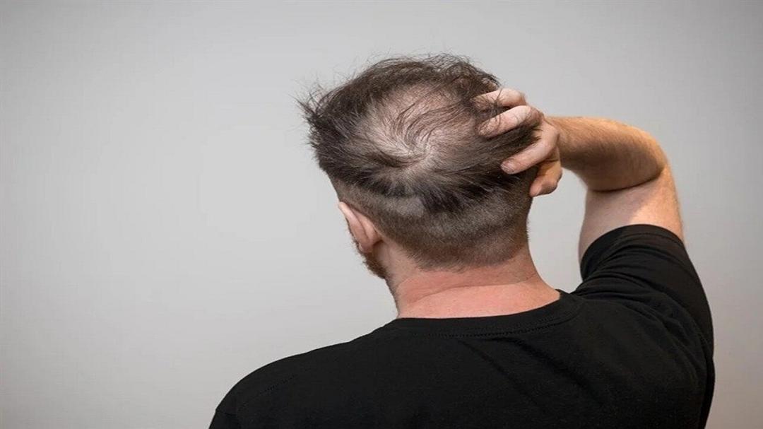 Un nuovo studio collega le bevande zuccherate alla perdita dei capelli