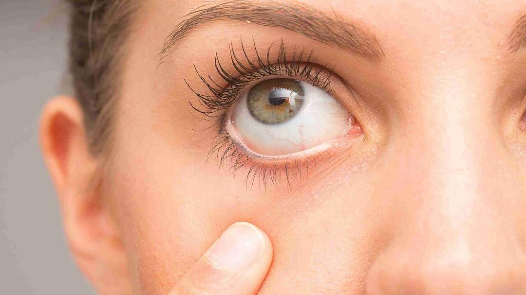 Milioni di adulti convivono con un disturbo agli occhi senza sapere che può essere trattato facilmente