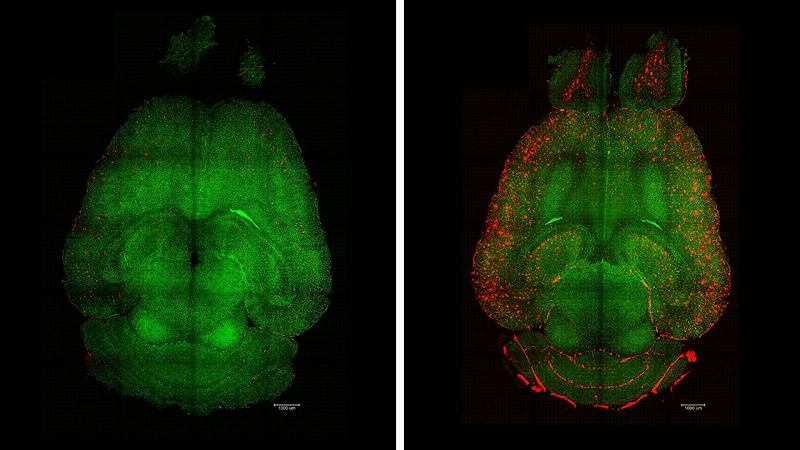 alzheimer, cura sperimentale mostra risultati sorprendenti