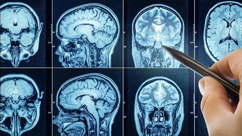 dormire male accelera l'invecchiamento del cervello