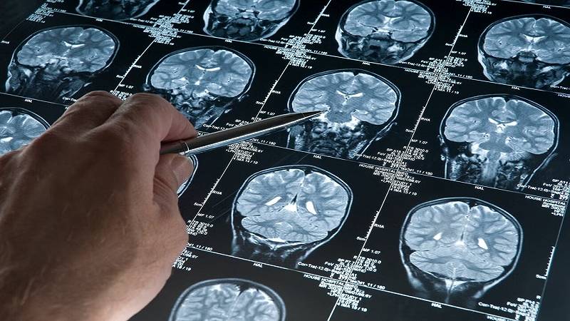 risonanza magnetica del cervello