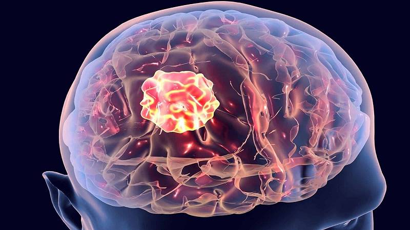 migliorata la classificazione dei tumori cerebrali